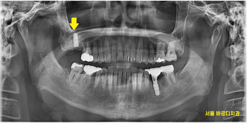 강동구 임플란트 뿌리 염증 심해질경우 대처 방법 관련 이미지 5