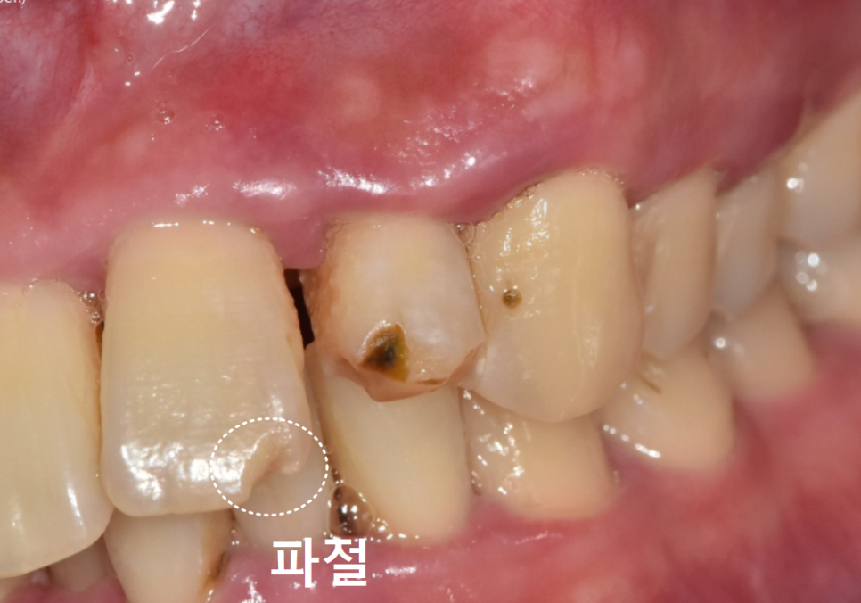 강동구 앞니 충치, 누구는 레진이고 누구는 임플란트인 관련 이미지 8