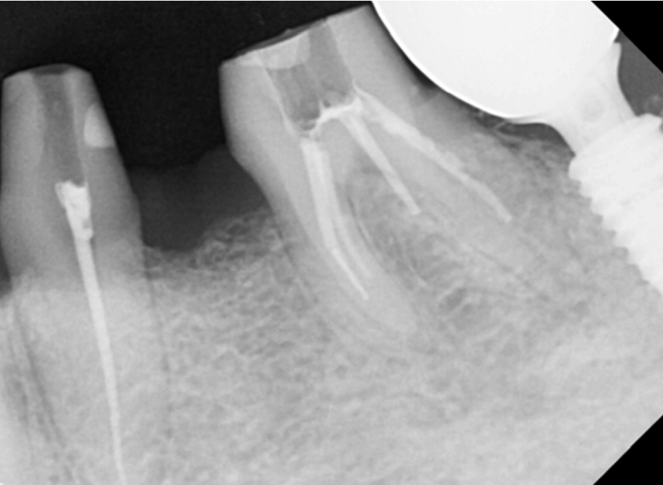 고덕동치과 서울바르디치과 전치부 및 구치부 임플란트 치료증례 #9 관련 이미지 29