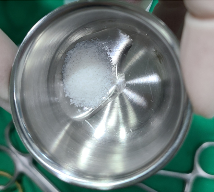 강일동 임플란트 뼈이식재 종류는 뭔가요? 안전성이 걱정되신다면 필독 관련 이미지 3