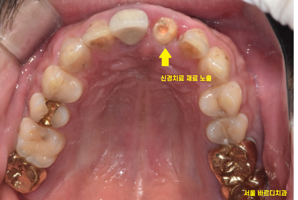앞니 부러짐 손상이 커서 하남선동치과에서 임플란트 치료 관련 이미지 3