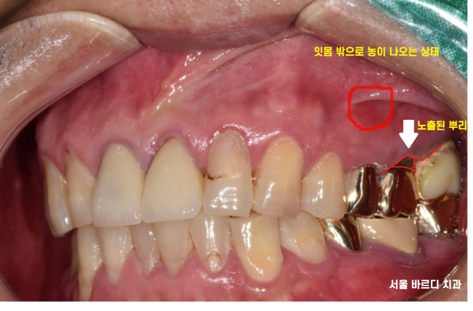 하남 미사 치과 발치 후 당일 임플란트가 가능합니다. 관련 이미지 3