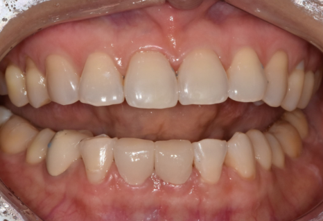 앞니 레진 떨어짐, 자꾸 반복된다면 관련 이미지 12