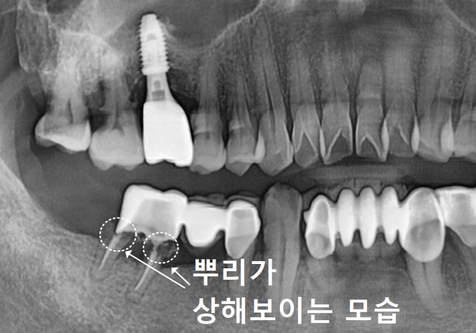 고덕동 어금니 브릿지 교체, 관련 이미지 7