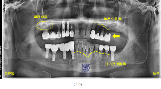 미사 임플란트 70대 연령과 상관없는 치료 과정 관련 이미지 1
