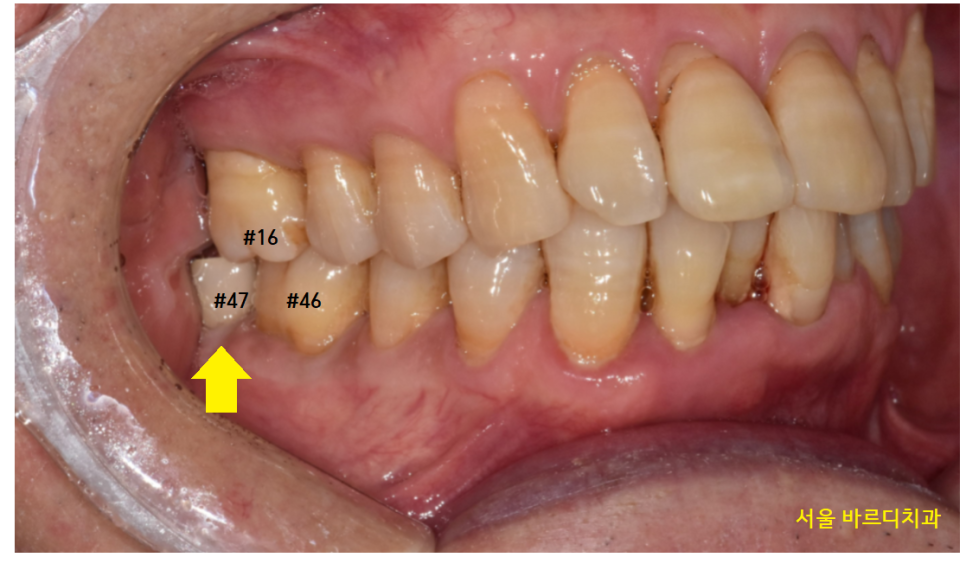암사동 치과 임플란트 꼭 안 해도 되는 경우 궁금증 해결해 드려요 관련 이미지 5