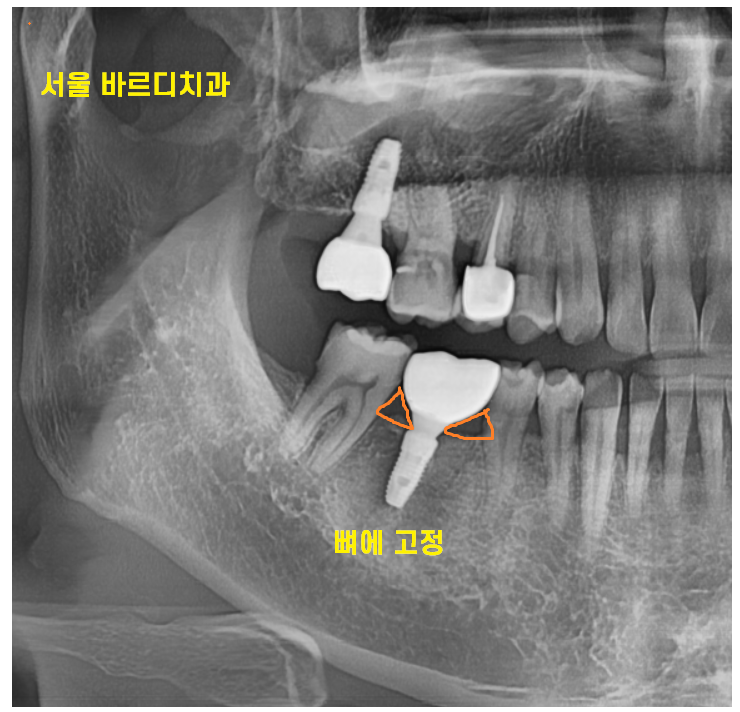 풍산동 치과 임플란트 음식물 끼임 원인과 해결방법은?? 관련 이미지 4