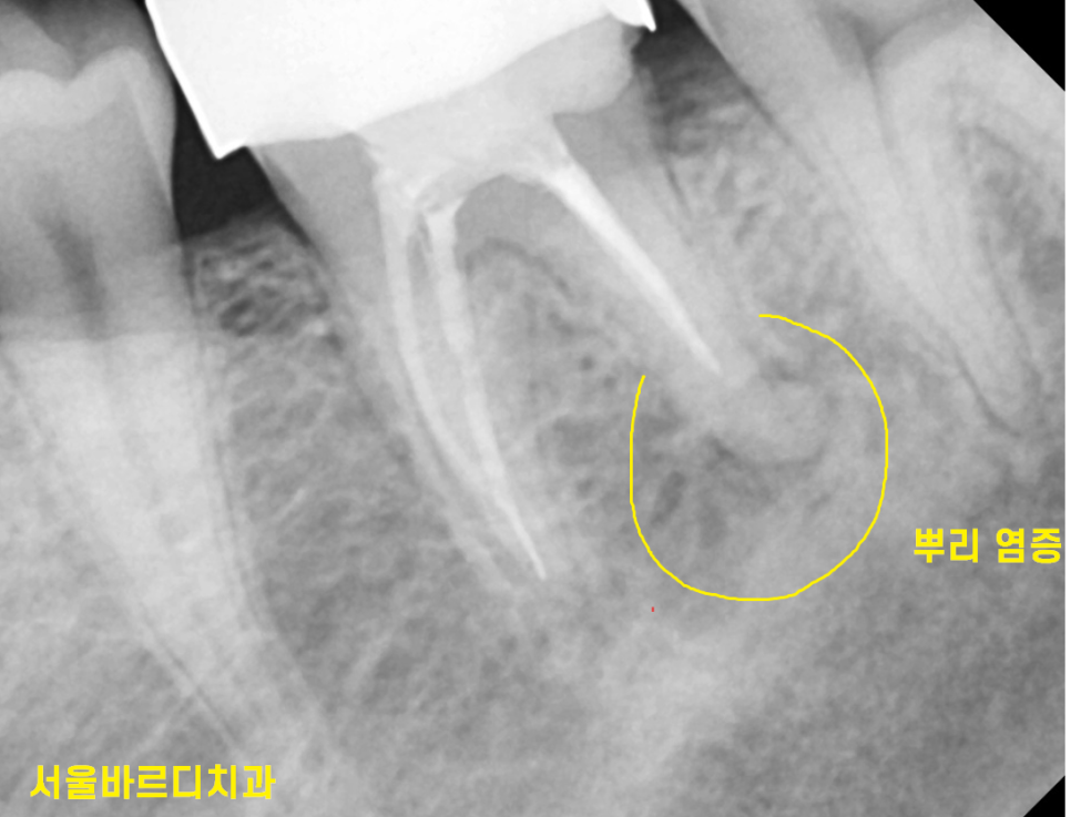 신경치료 염증 치아 다시 한번 치료하여 자연치아 살렸습니다. 관련 이미지 2