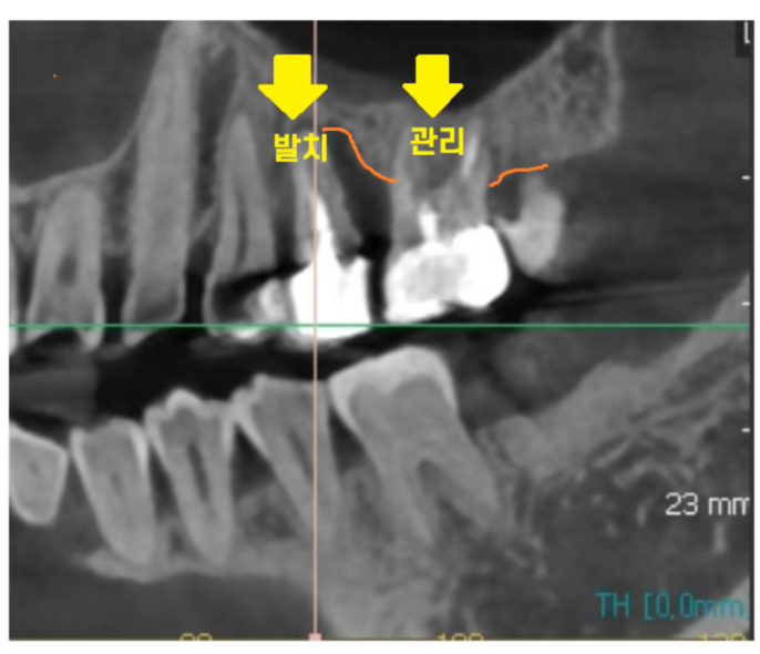 상일동 임플란트 수술 과정 시작부터 끝까지 따라와주세요! 관련 이미지 4