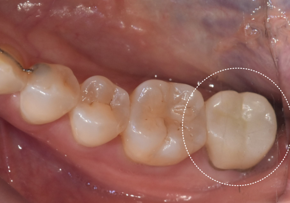 강동구 치아 뿌리 염증, 신경치료 한 치아인데도 아플 수 있나요? 관련 이미지 6
