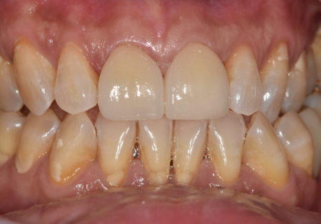 고덕동 치과 누런 이, 앞니 사이 틈, 잘못된 관리 때문일까? 관련 이미지 15