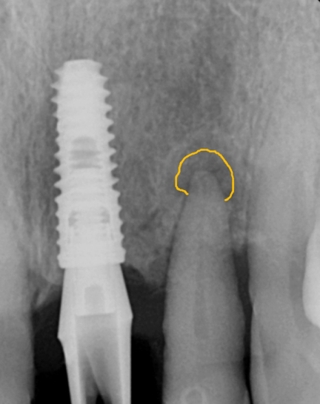 고덕동 임플란트, 튀어나온 앞니, 비용은 줄이고 자연스럽게 개선한 실제 사례 관련 이미지 4