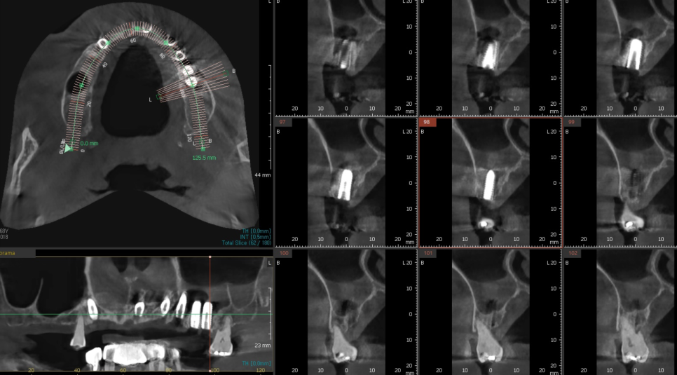 뿌리만 남은 치아, 그대로 두면 왜 위험할까요? 고덕동 전체 임플란트 재건 사례 관련 이미지 14