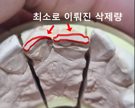 앞니 덧니, 교정은 싫고 시간은 없다면? 라미네이트로 해결한 사례 관련 이미지 10