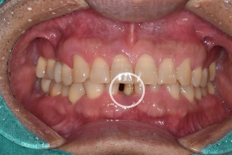 My Teeth Are Shaking So Much That Eating Is Uncomfortable—Is It Okay to Just Leave Them Alone? image 3