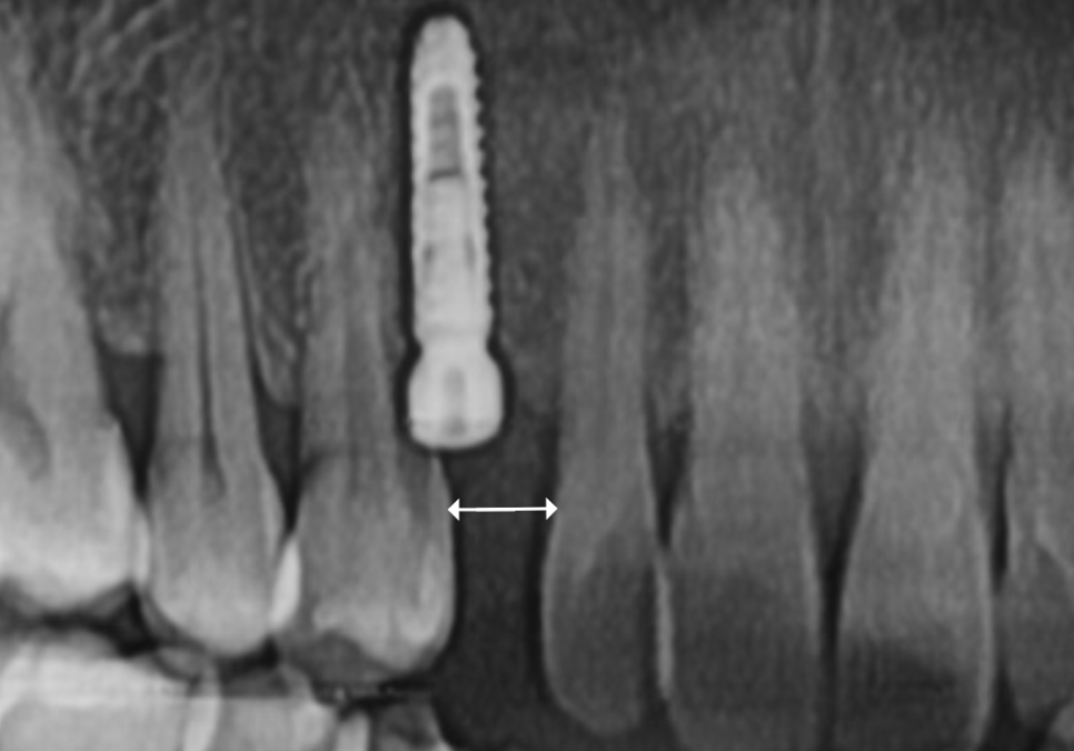 흔들리는 성인 잔존 유치, 50년 만에 송곳니 임플란트 하게 된 사연 관련 이미지 10