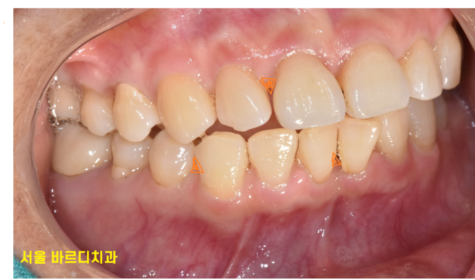 음식물 끼임 생겼다고 이쑤시개 쓰면 안되는 이유 관련 이미지 5