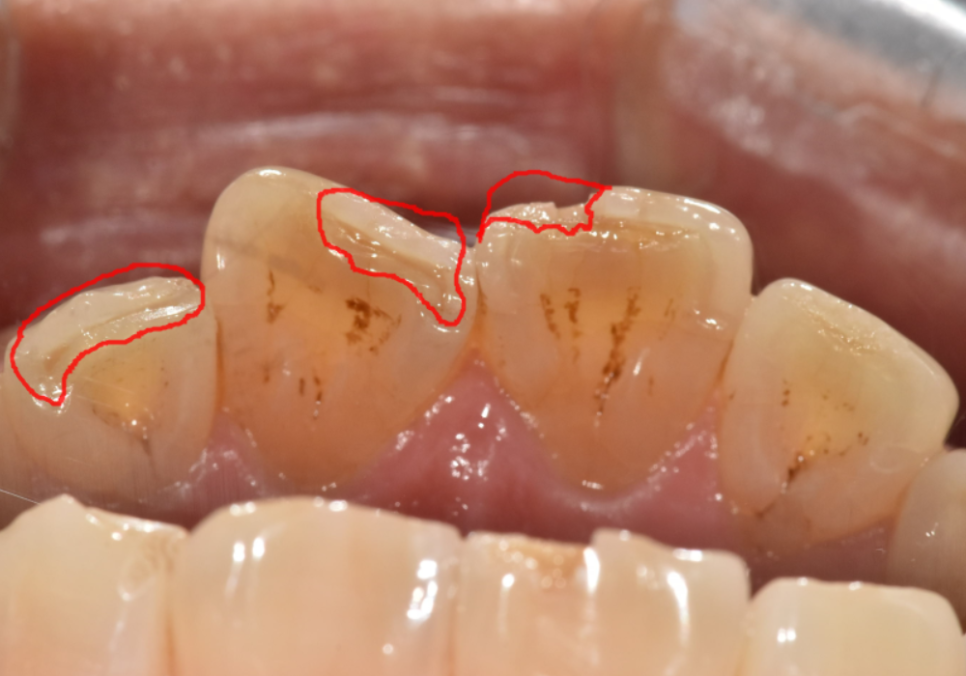 앞니 깨짐 치료 비용, 더이상 치과에 돈 낭비하기 싫다면? 깨지는 원인부터 알아야 합니다. 관련 이미지 1