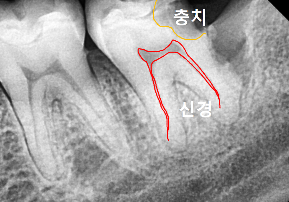 If you lightly brush your backmost molar because the toothbrush can’t reach it, this is what happens. image 2