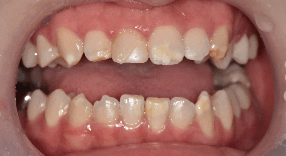 강동구 라미네이트, 치아 하얀 반점 없애고 싶다면? 치료 방법 관련 이미지 5