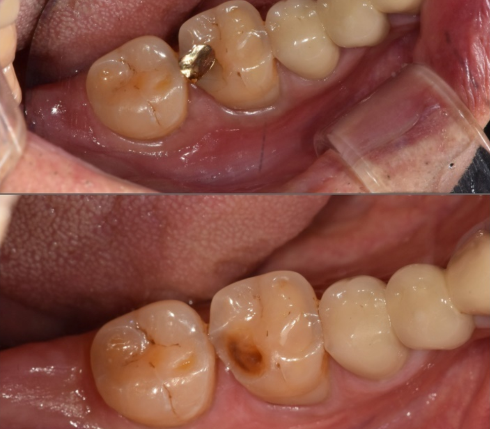 시큰거리는 통증, 시린 이 치약으로 해결 안 된다고요? 관련 이미지 4