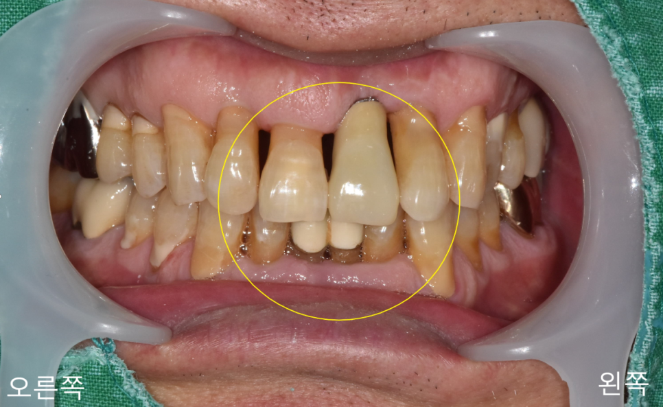 상일동치과 서울바르디치과 무절개 네비게이션 임플란트 치료증례 #3 관련 이미지 13