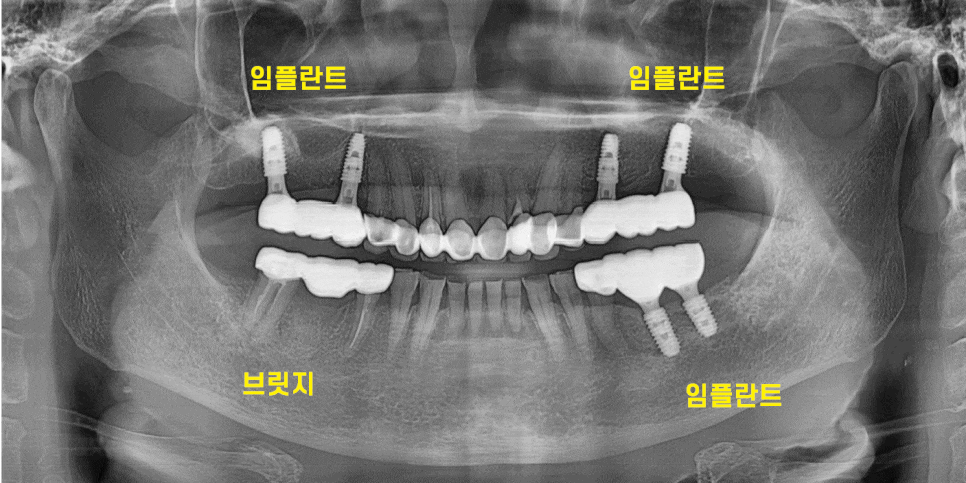 하남 임플란트 치과 주문진에서부터 치료 받으러 오신 환자분 관련 이미지 1