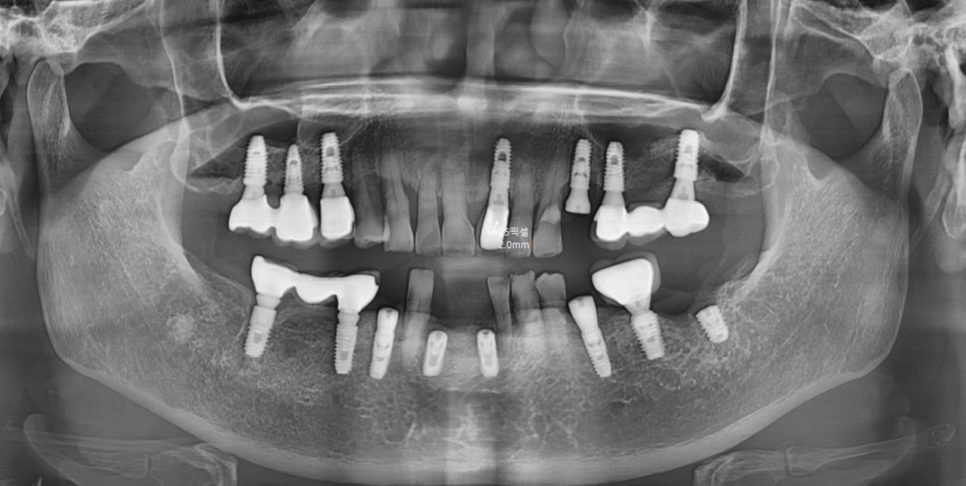 Restored 3 Teeth with Implants After Lower Front Teeth Became Loose and Fell Out image 6