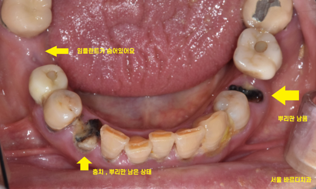 타치과 임플란트 as 수리 가능한 선동치과 관련 이미지 4