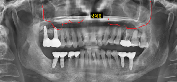 미사역 임플란트 상악동염으로 치아를 발치한 사연 관련 이미지 2