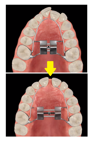 소아 악궁확장 RPE장치란? 성장기 1차 교정 진행해야할 때 관련 이미지 5