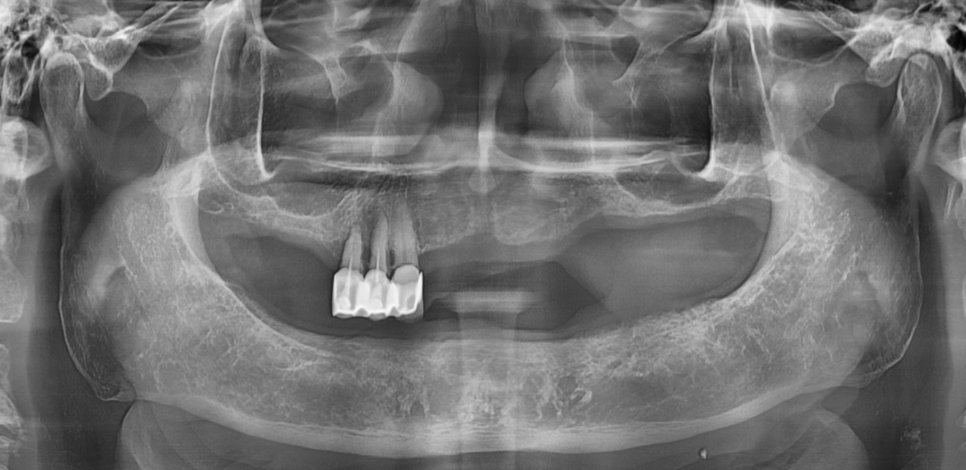 치아 상실 치료 치과 브릿지? 임플란트? 무엇이든 시도하세요. 관련 이미지 2