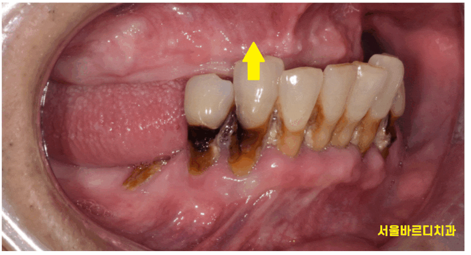 틀니 쓰다가 임플란트 어려움은 ? 높이를 높여주는게 킥!!! 관련 이미지 1