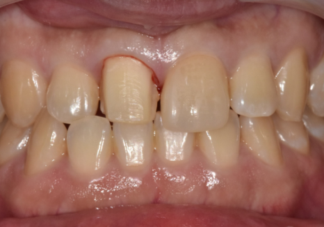 천호 라미네이트 파절 탈락, 줄이려면 치과 선택이 중요합니다. 관련 이미지 13