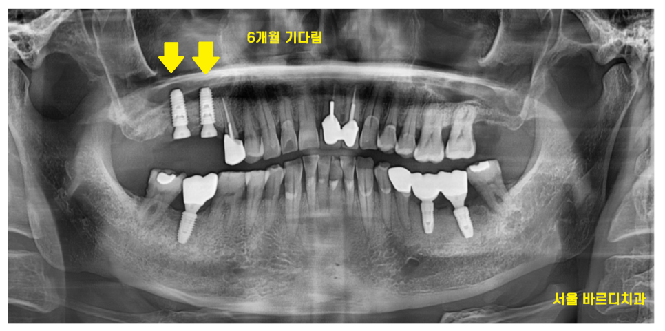 상일동 임플란트 치아 솟음으로 불편함을 느낄 때 관련 이미지 7