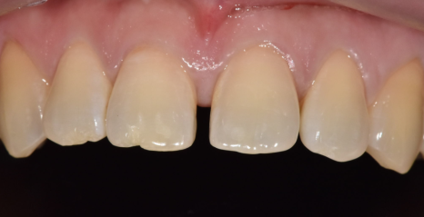 고덕동 치간 이개, 위 앞니 벌어짐, 교정? 라미네이트? 고민이시라면 필독 관련 이미지 10