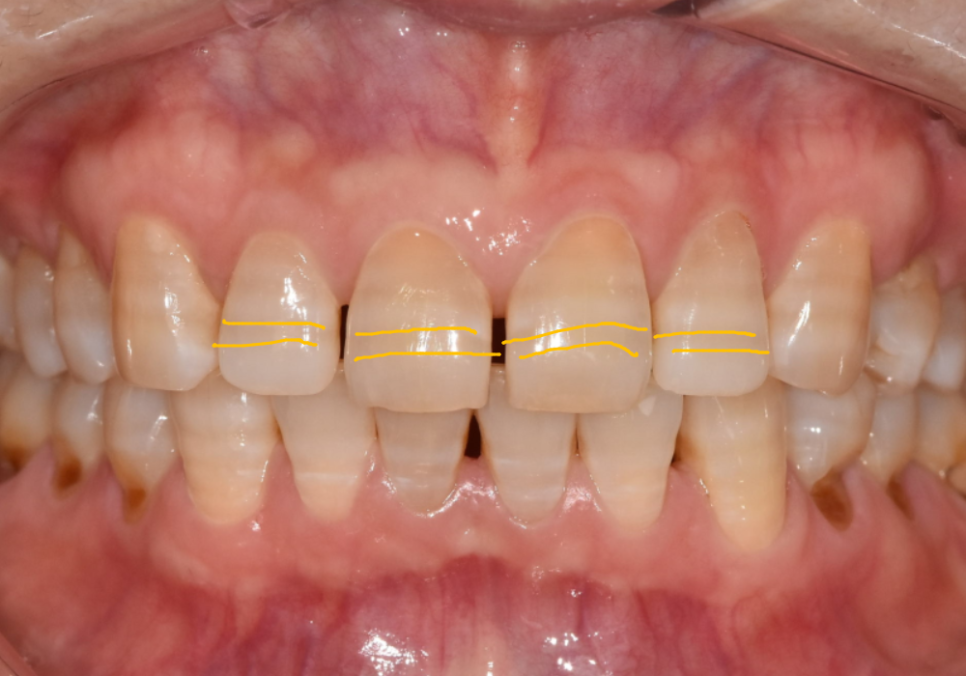 앞니 변색, 치아미백효과 없는 이유 솔직하게 말씀드립니다. 관련 이미지 1