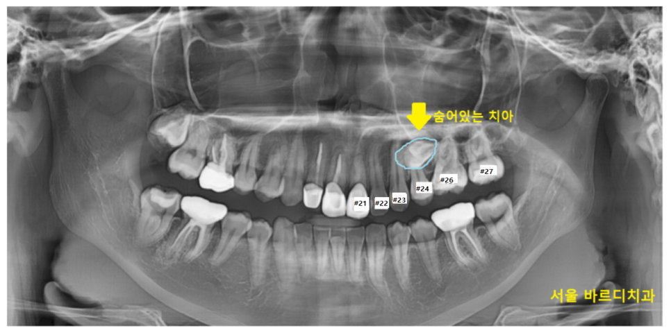 덕풍동 치과 교정 치료 위해 숨어있는 매복치 수술 발치 문제없습니다 관련 이미지 2