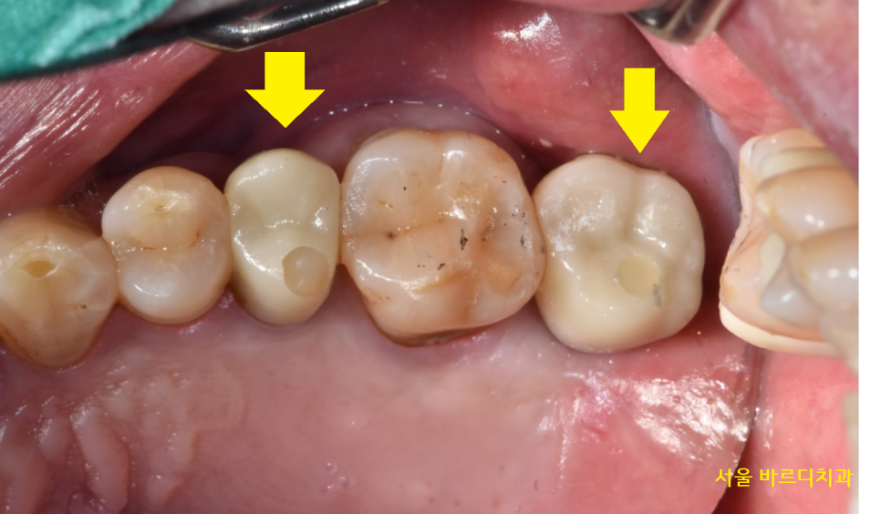 덕풍동 치과 임플란트 불가 판정받으신 환자분 살렸습니다. 관련 이미지 9