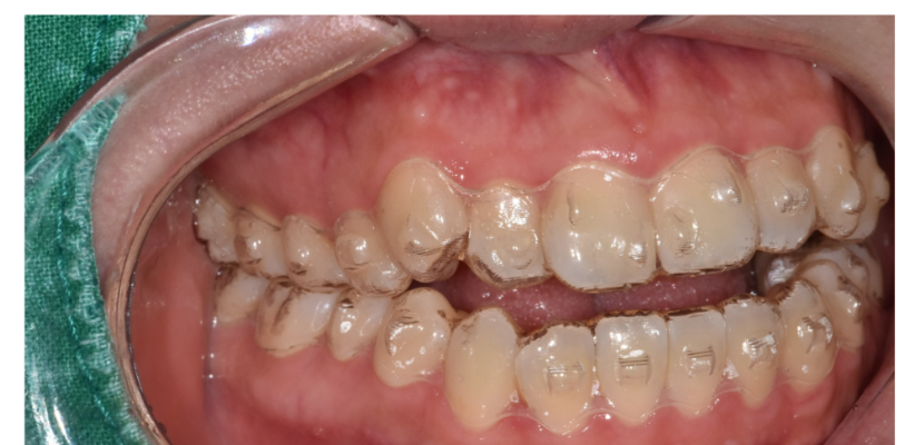 고덕동 투명교정은 발치 안 한다? 그건 오해입니다 관련 이미지 4
