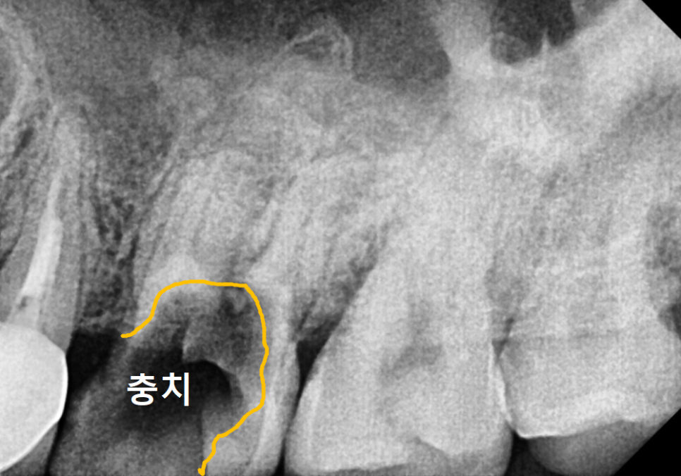 어금니 구멍, 충치 솔직하게 말씀드립니다. 치과 공포증으로 미루신 분들 필독 관련 이미지 3