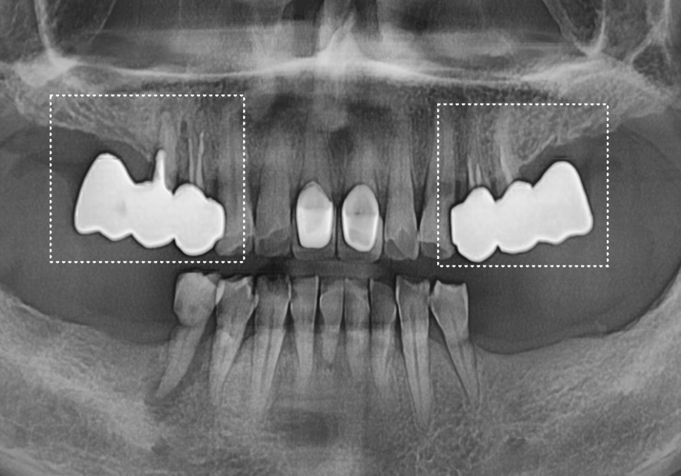 강동구 임플란트 가격 줄이는 방법 2개 발치했는데, 1개만 심어도 된다구요? 관련 이미지 7