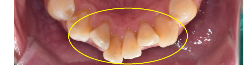 치아 교정 중 치간 삭제 치아를 깎는다고요??? 관련 이미지 3