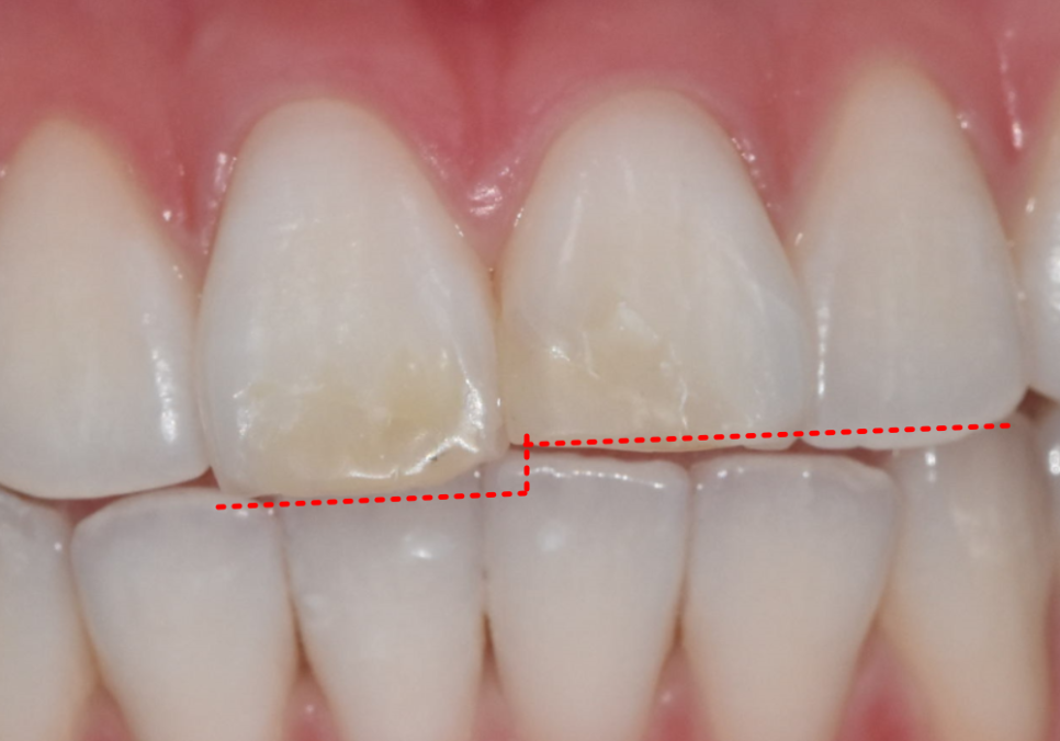 절단교합으로 인한 앞니 레진 깨짐, 교정 없이 해결한 사례 관련 이미지 6
