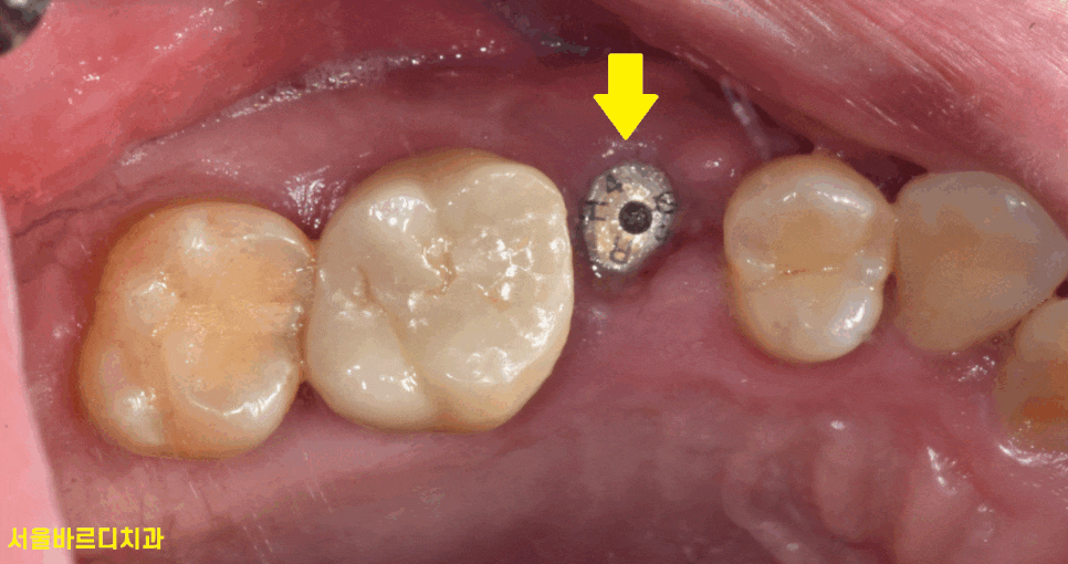 풍산동 치과 어금니 쪼개짐 임플란트를 해야할 때는? 관련 이미지 1