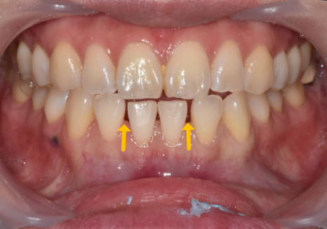 고덕동 무삭제 라미네이트, 실패 없이 하려면 꼭 확인할 3가지 관련 이미지 4