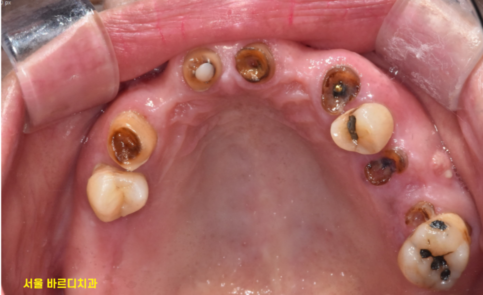 고덕역 치과 위아래 전체 임플란트 디지털을 사용하는 이유? 관련 이미지 3