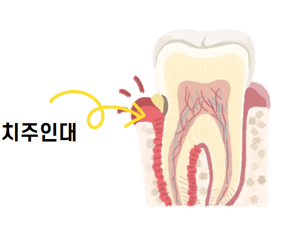 고덕동 임플란트 점검을 꼭! 받으러 와야하는 3가지 이유 관련 이미지 4