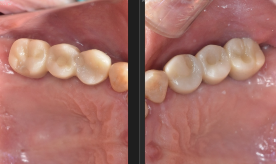 Gangil-dong Molar Implant, "It’s Loose—Can’t You Just Bond It with Resin?" image 15