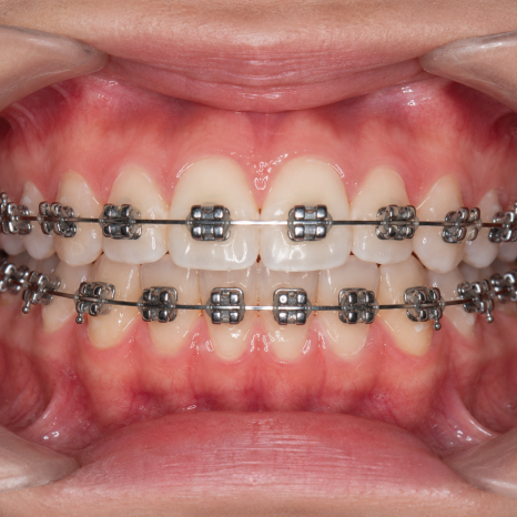 Why Does My Mouth Look More Protruded During Orthodontic Treatment, and When Will It Improve? image 1